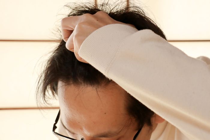 10代のAGA対策はどうすればいい?という若者が増えているのは事実